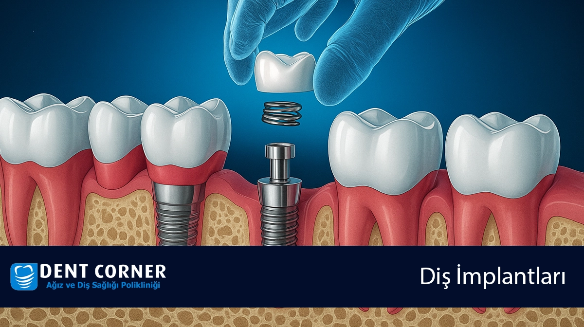 Diş İmplantı için Hangi Doktora Gitmeliyim?