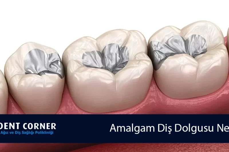 Amalgam Diş Dolgusu Nedir? Neden Sökümü Tavsiye Edilir?