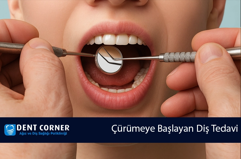 Çürümeye Başlayan Diş Tedavi Edilmezse Ne Olur?