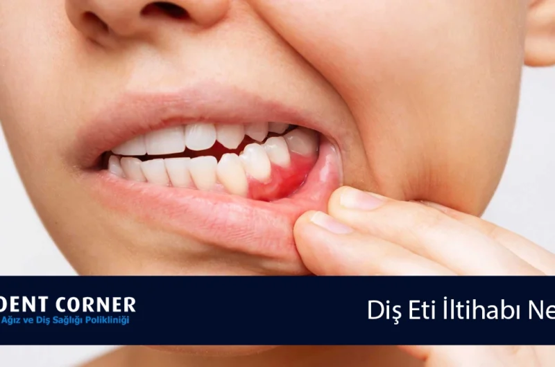 Diş Eti İltihabı Nedir? Diş Eti İltihabına Ne İyi Gelir?