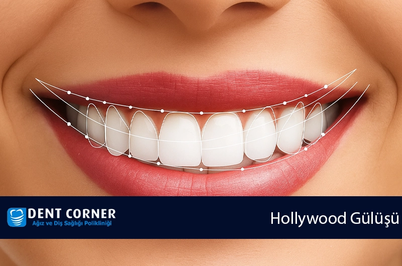Hollywood Gülüşü Nedir? Nasıl Sağlanır?
