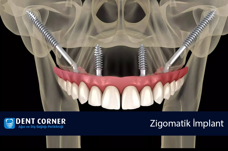 Zigomatik İmplant Tedavisinde Bilinmesi Gerekenler