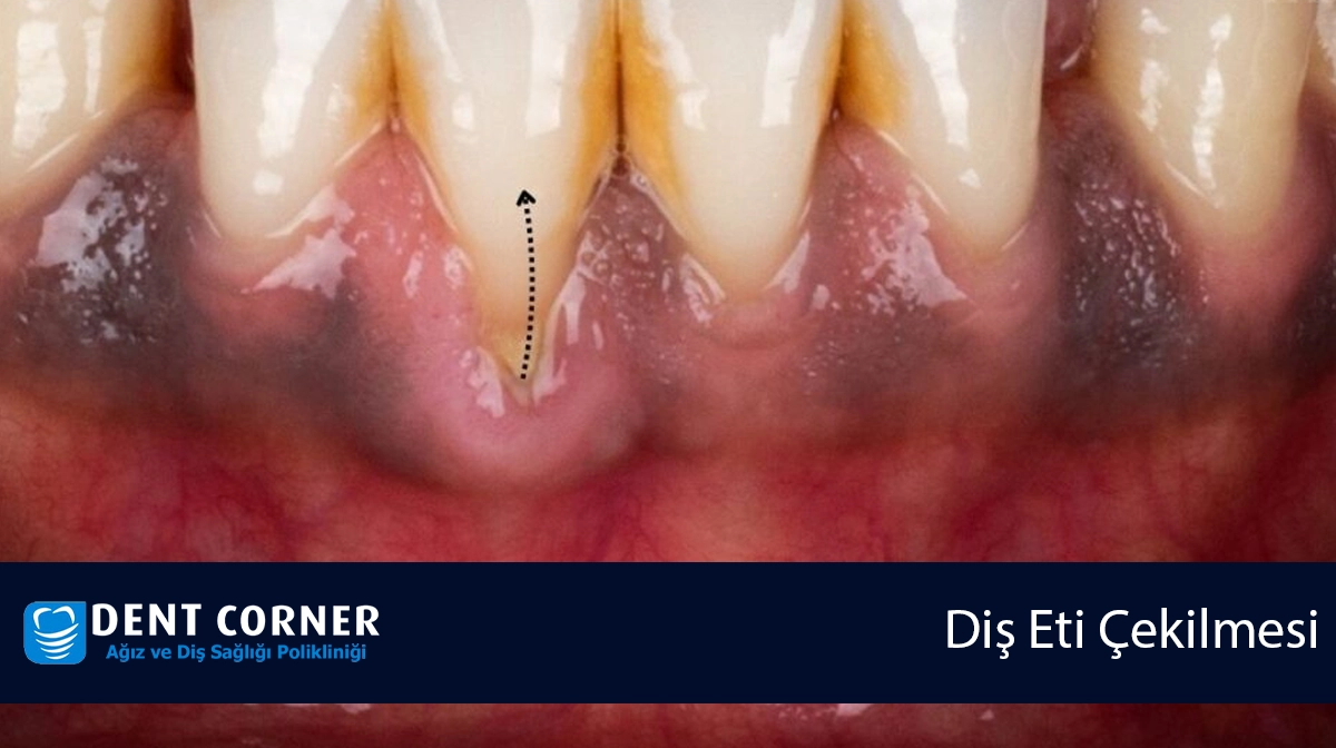 Diş Eti Çekilmesi (Periodontitis) Belirtileri Nelerdir? Diş Eti Çekilmesine Ne İyi Gelir?