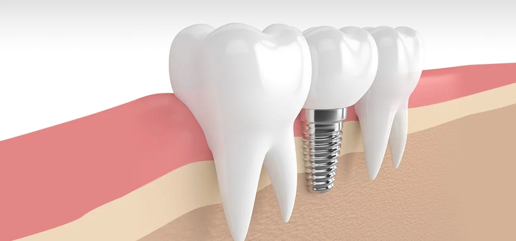Dental implant görseli