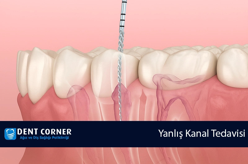 Yanlış Kanal Tedavisi Sonuçları: Neden Önemli ve Nasıl Önlenir?