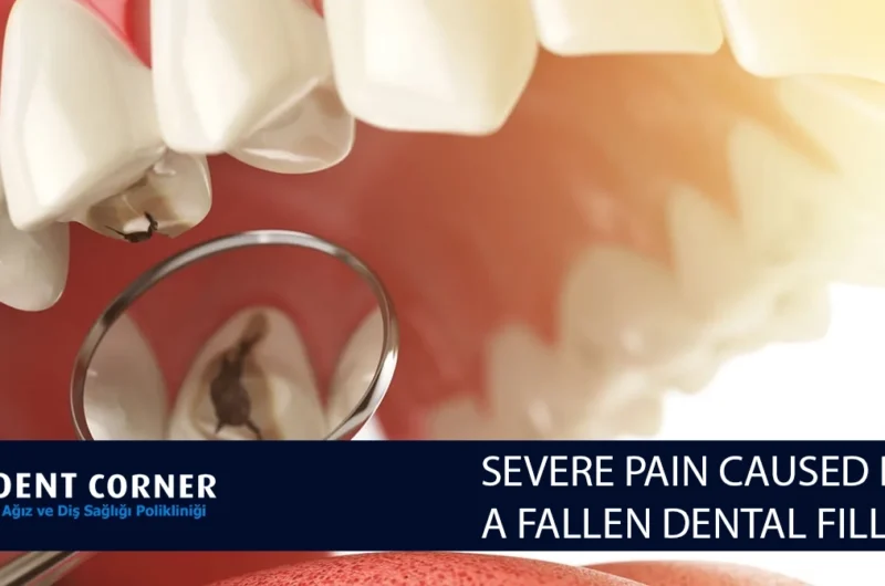 SEVERE PAIN CAUSED BY A FALLEN DENTAL FILLING